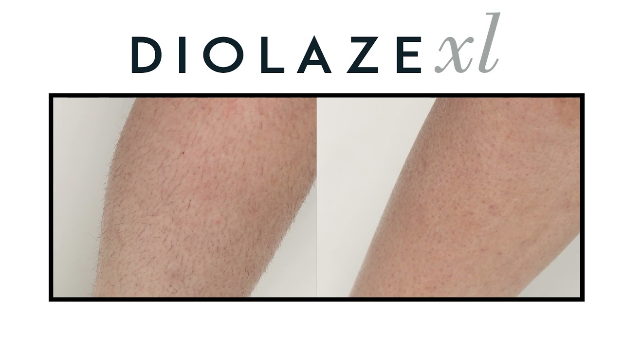 Diolaze